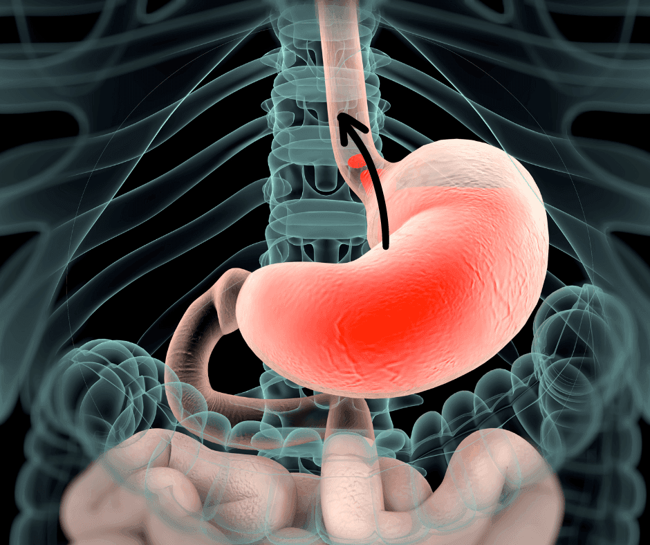 Top 8 tips to fix your acidity at home
