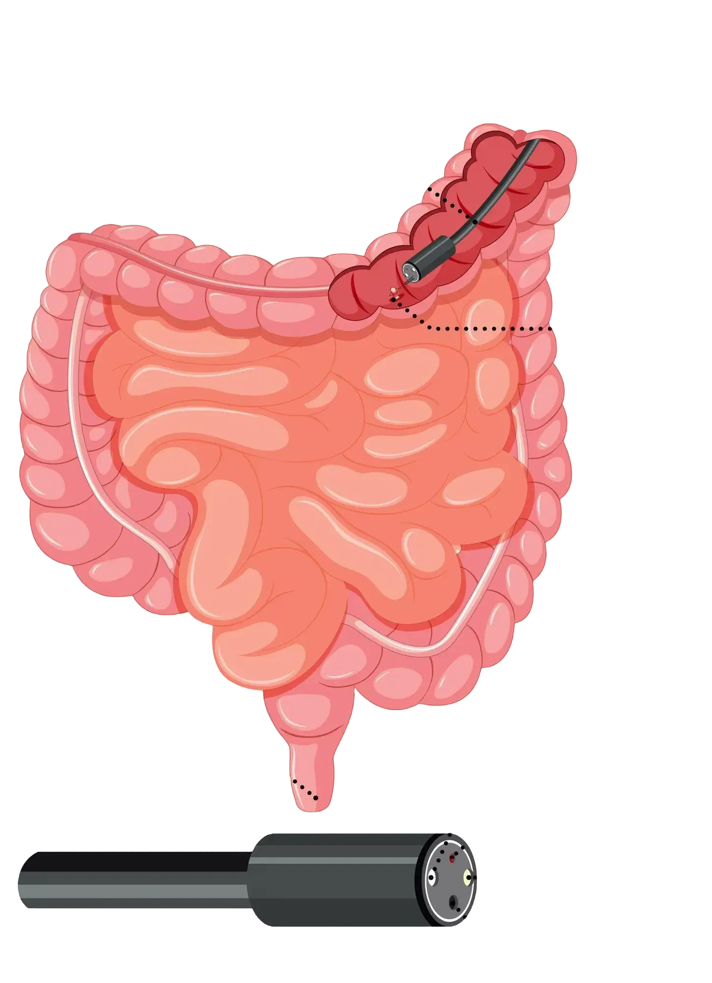 What to do and not to do before a colonoscopy?