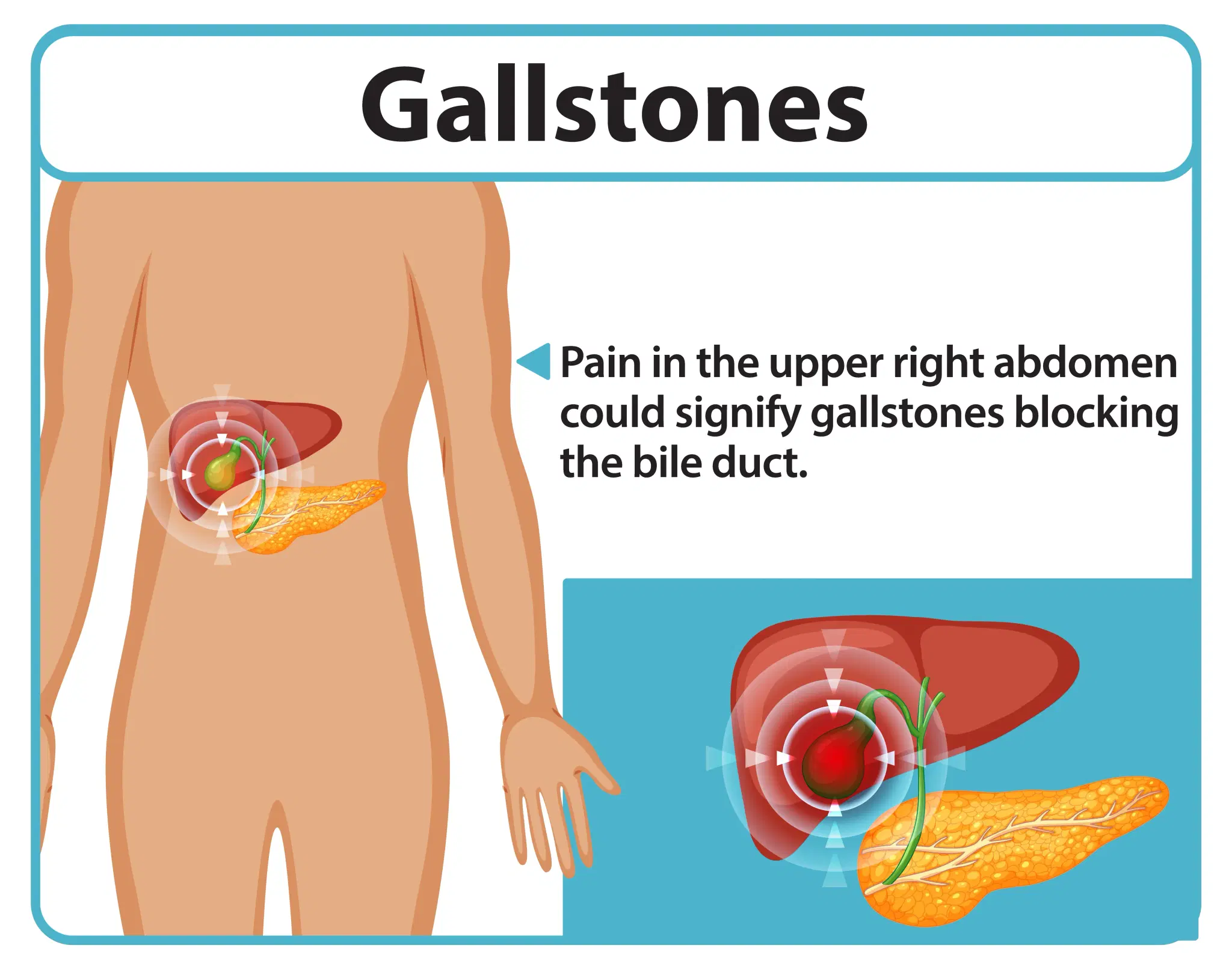 What causes gallstones?