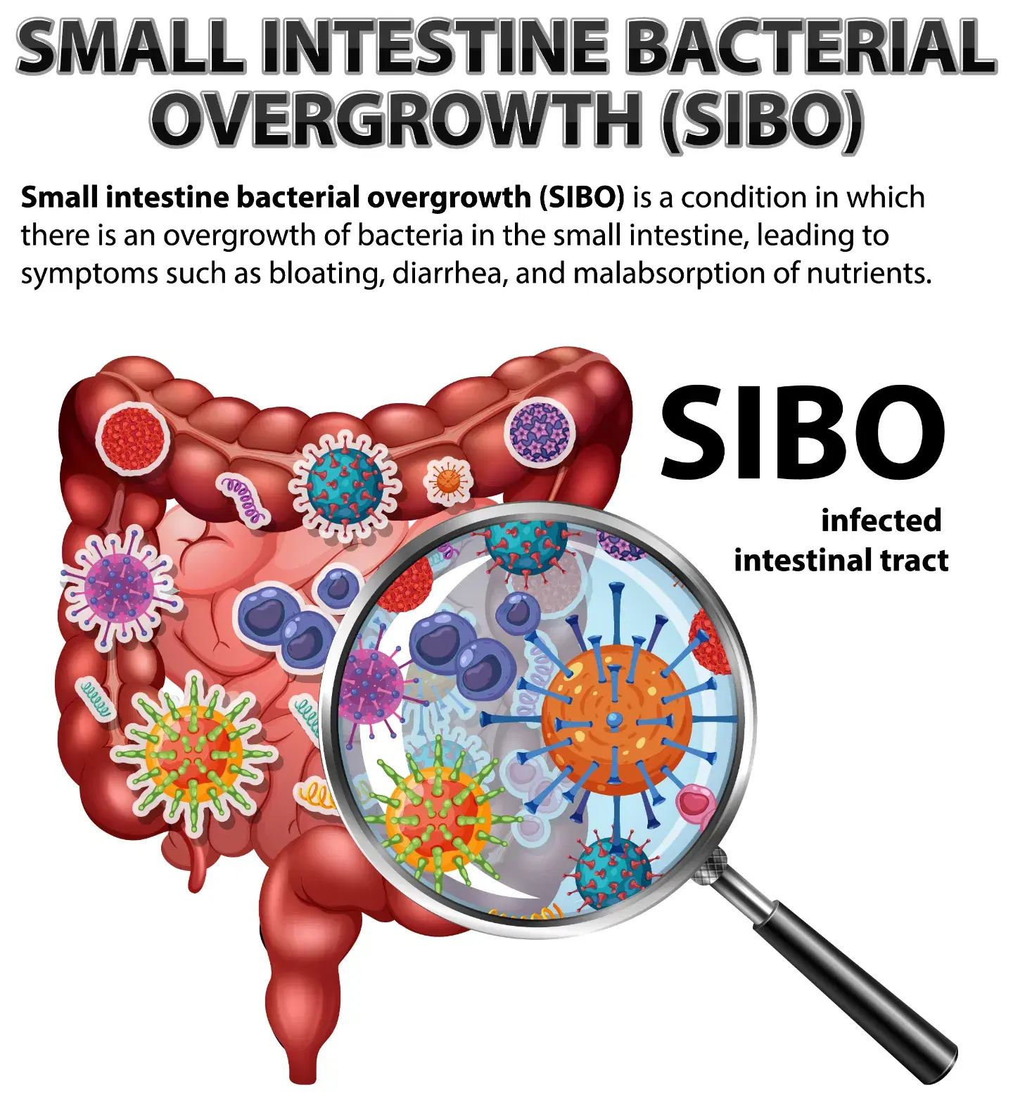 SIBO: Complete Guide to Symptoms, Causes & Treatment Options