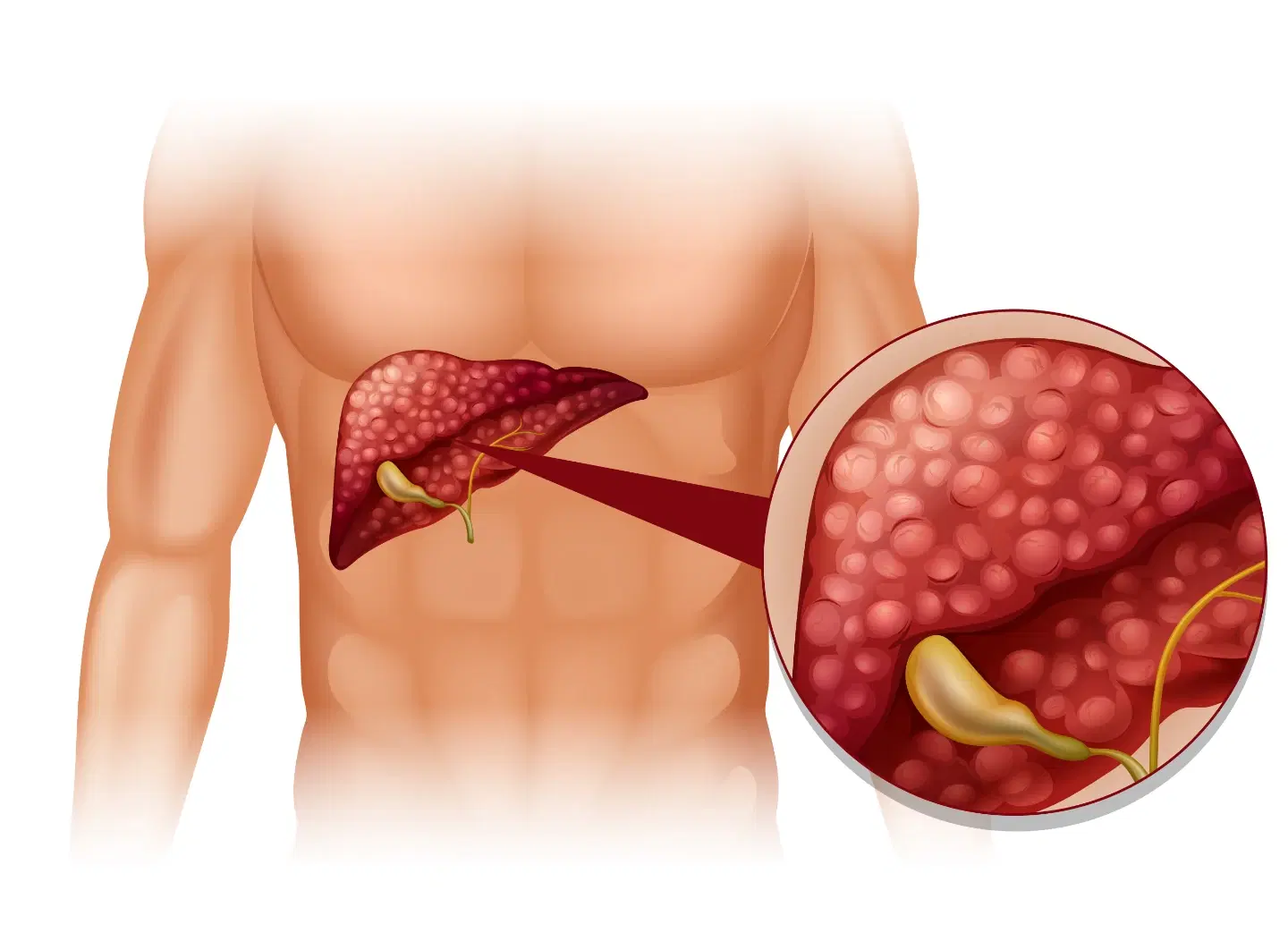 Gallbladder Polyps: Causes, Diet & When Surgery Is Needed