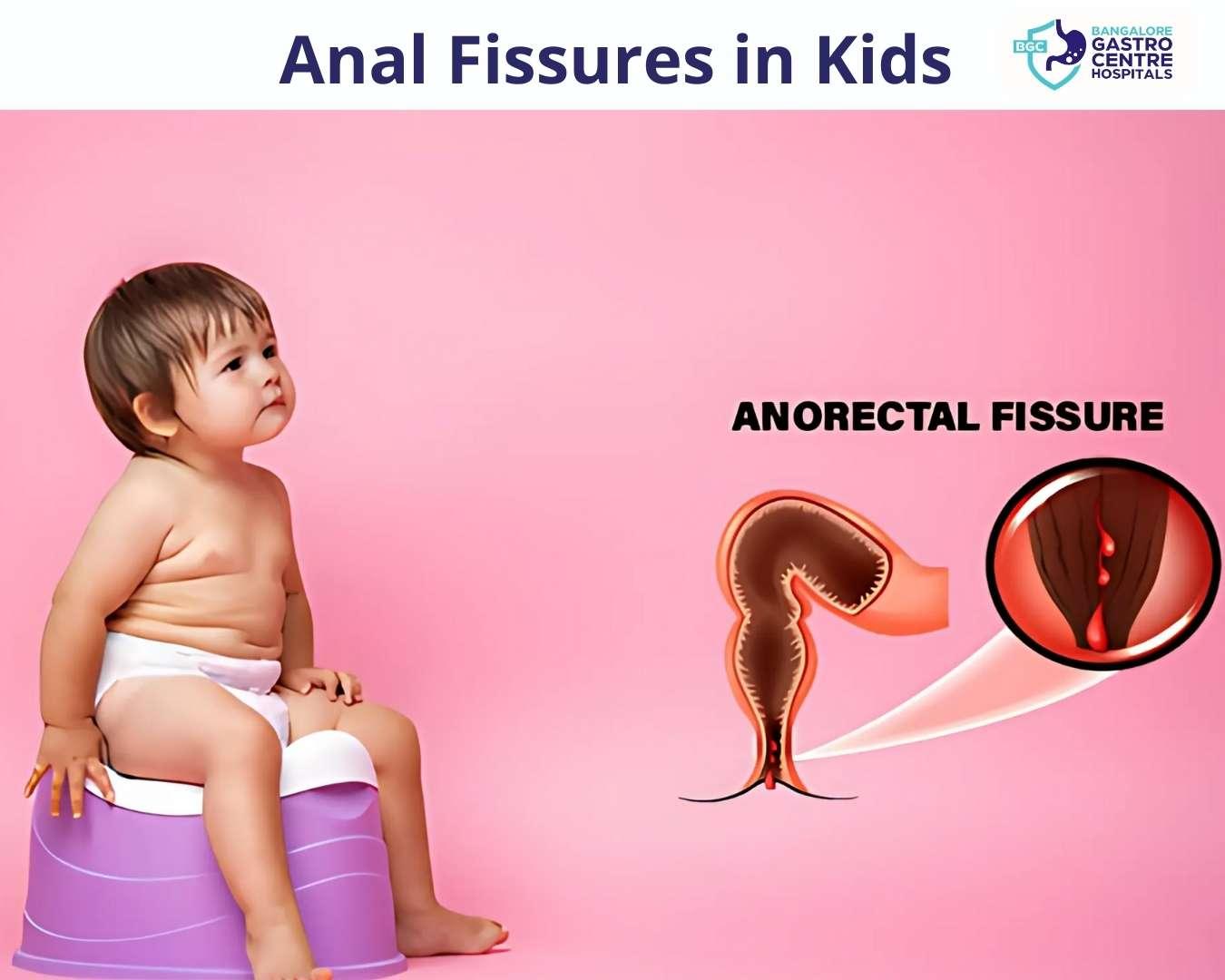 Anal Fissures in Kids: What Parents Should Know