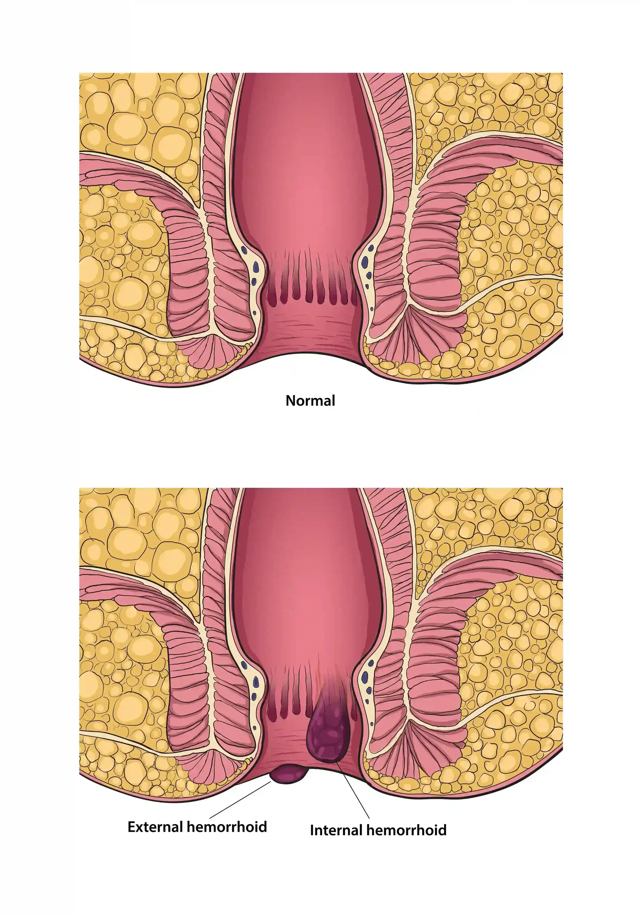 Anal Skin Tags: Causes, Safe Removal & Treatment Guide