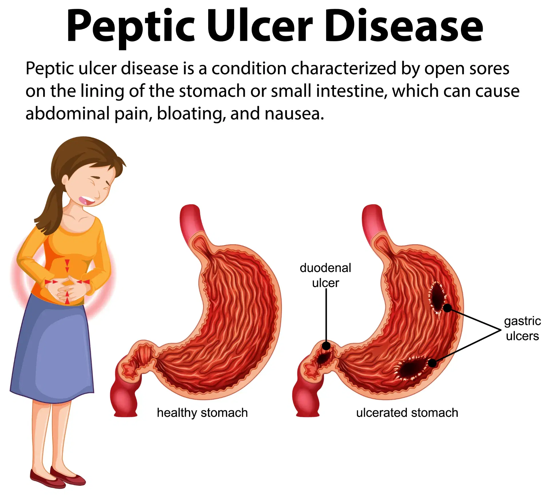 Peptic Ulcer Treatment: A Complete Healing Guide