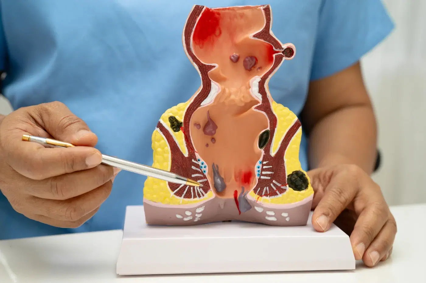 Anal Skin Tags: Causes, Treatment & When to See a Doctor